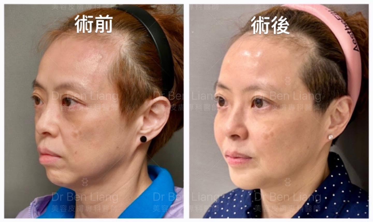 Volume Placement 與臉部結構層次案例追蹤